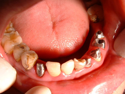 牙齿烂个洞是拔牙还是补_补牙齿洞要多少钱_牙齿烂个洞补好多少钱